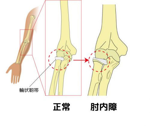 肘内障とは