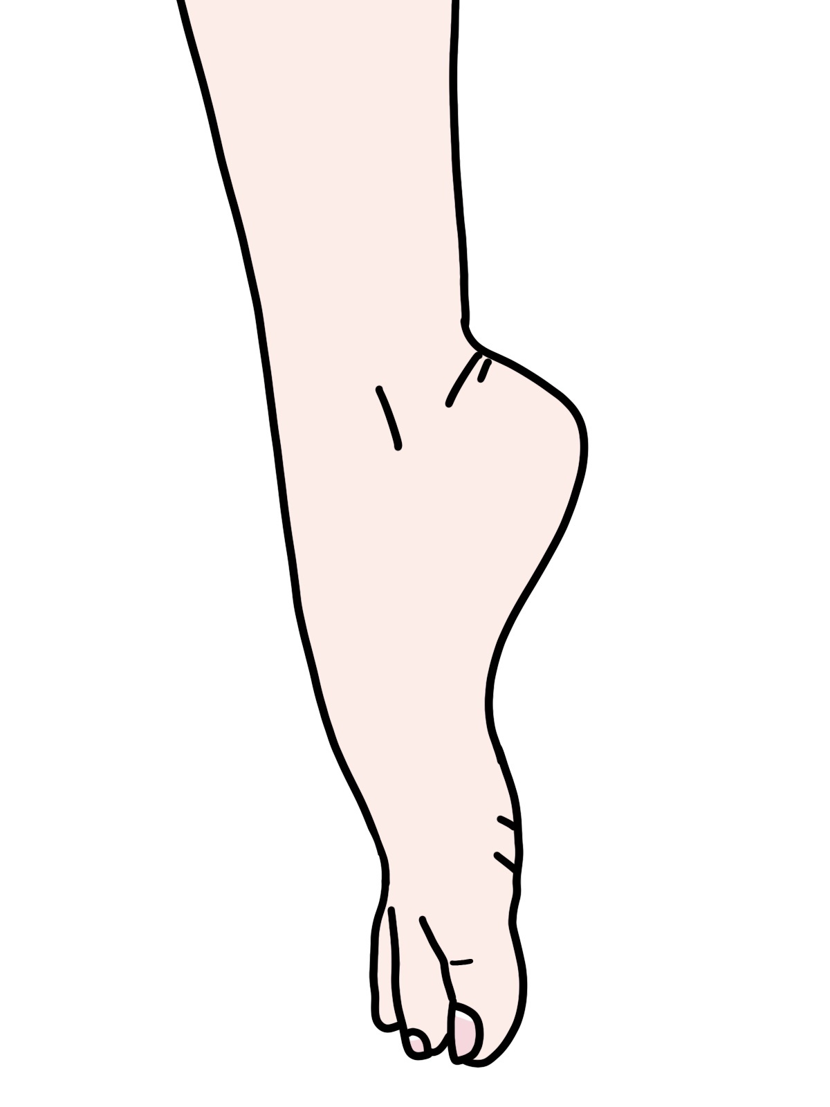 腓骨神経麻痺