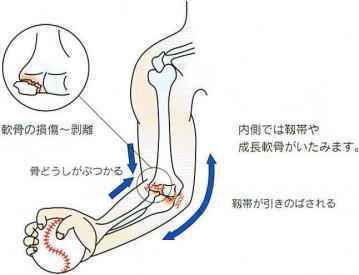 足底筋膜炎の鍼灸治療の様子