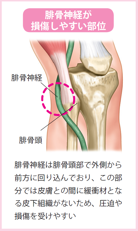 腓骨神経麻痺