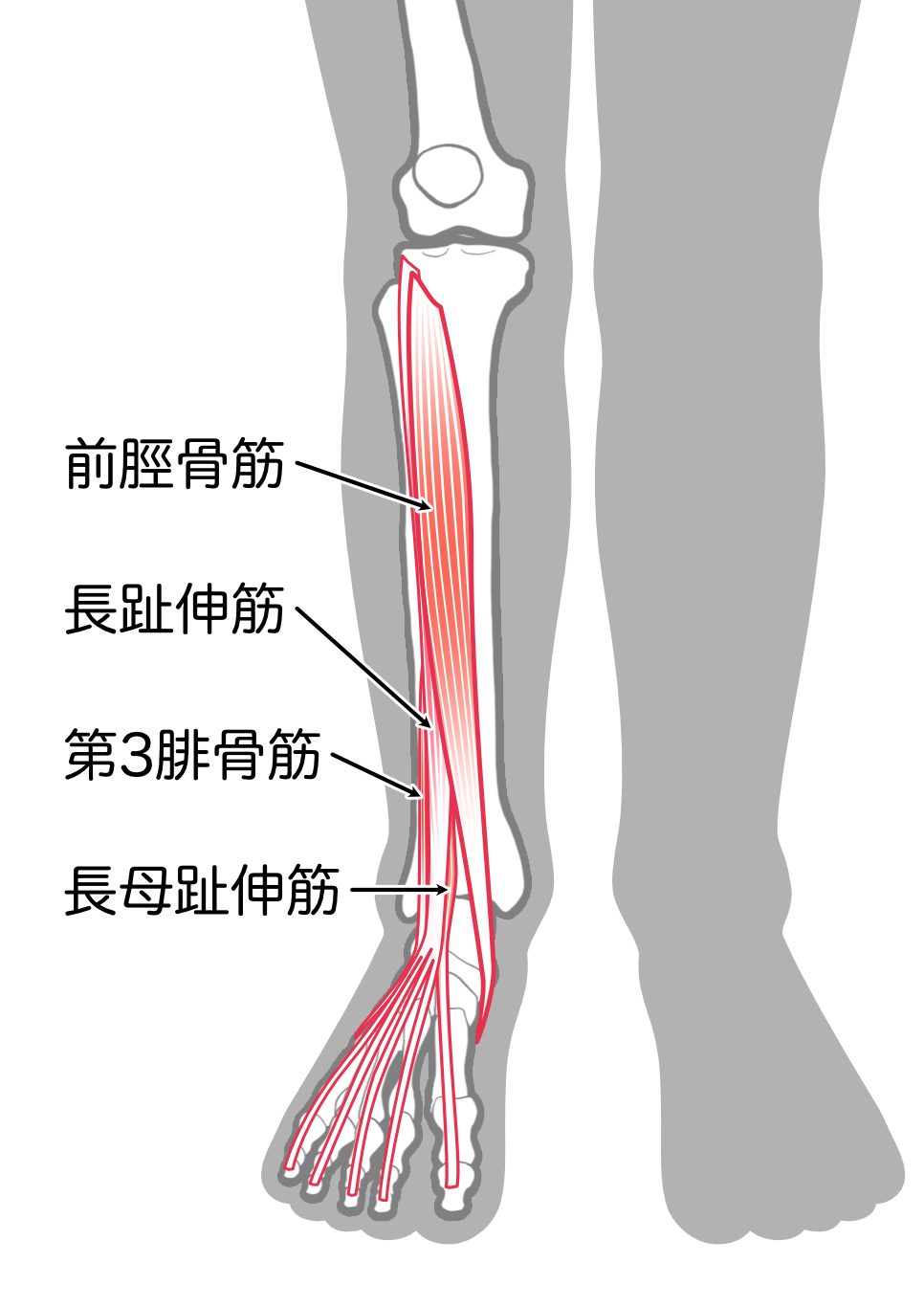 腓骨神経麻痺